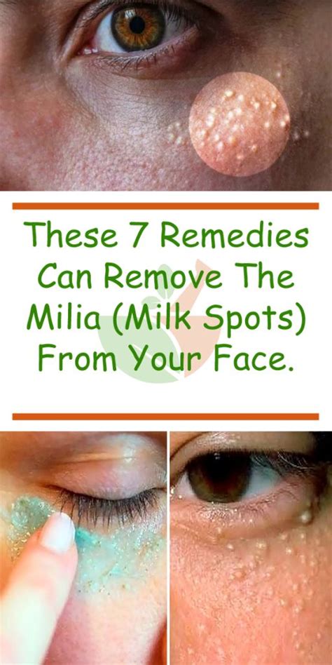 These 7 Remedies Can Remove The Milia Milk Spots From Your Face Our