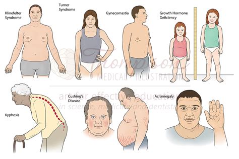 endocrine disorders illustration by thompson medical illustration medical illustration and animation
