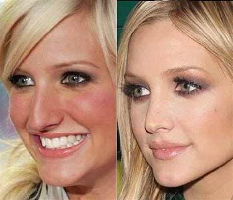 Celebrity Nose Before And After