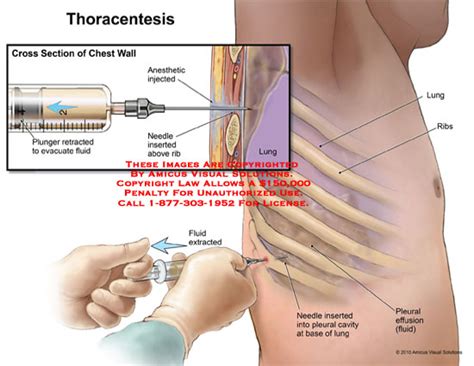 Results—there was greater variation in the range of histological appearances of mesotheliomas in figure 1 (a) biopsy of sarcomatoid mesothelioma (case 8). Mesothelioma Thoracentesis Therapy, used to address ...
