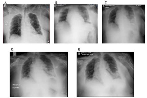 Dynamics Of Chest X Ray After Adding A Continuous Infusion Of