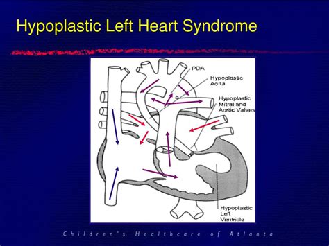 Ppt Hypoplastic Left Heart Syndrome And The Single Ventricle Repair
