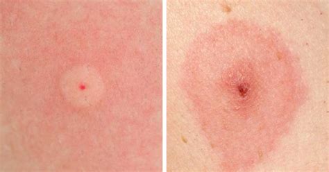 Types Of Insect Bites 5 Types Of Bug Bites You Should Never Ignore Womens Health The
