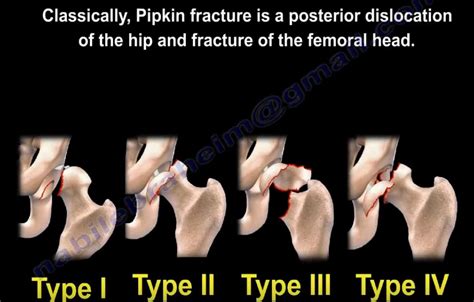 Classification And Types Of Hip Dislocation —