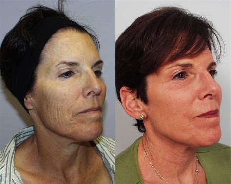 Fraxel Repair By Michael A Persky Md Facs 818 501 Face Plastic