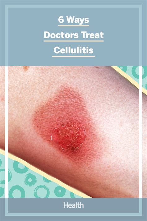 6 Ways Doctors Treat Cellulitis Cellulitis Treatment Bacterial