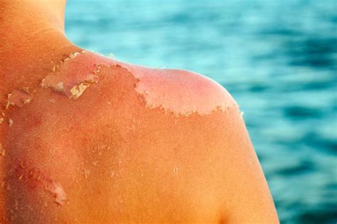 Sunburn Description Causes And Treatments
