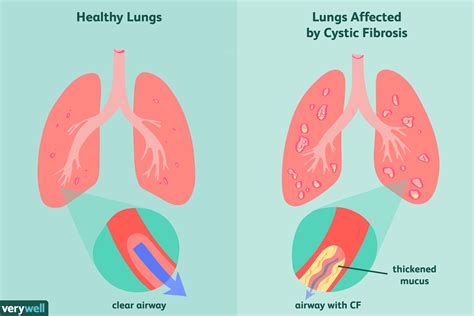 Cystic Fibrosis Cf Overview And More