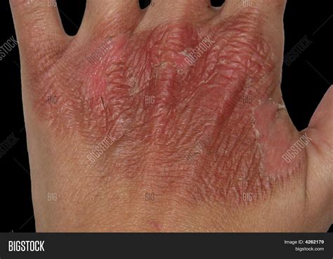 First degree burns are less severe than second degree burns and typically do not require medical treatment. First Degree Burns Image & Photo | Bigstock