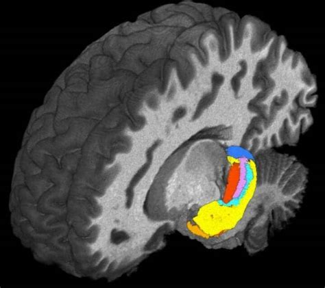 Ultra High Field Mri Detects Differences In Brains ‘hippocampus