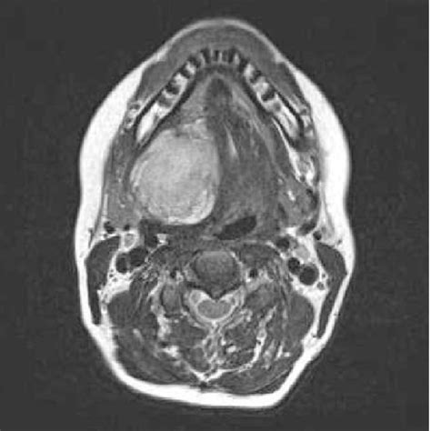 Image Showing The Mass Dislocating The Submandibular Space Download