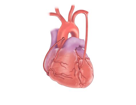 Coronary Artery Bypass Surgery Upmc Heart And Vascular Institute