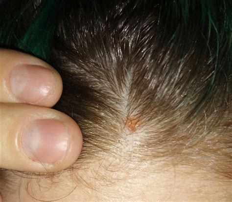 Bumps On The Scalp What Are Causes And Treatments Cba