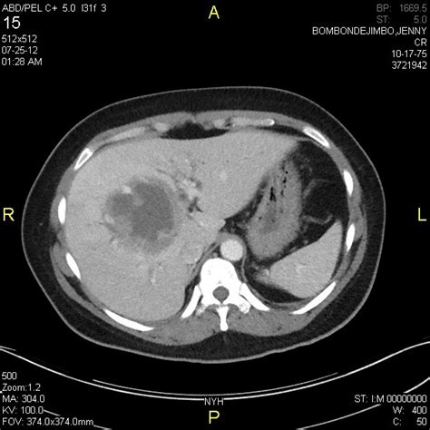 Liver Abscess Ct Scan