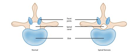 Lumbar Spinal Stenosis Orthoinfo Aaos