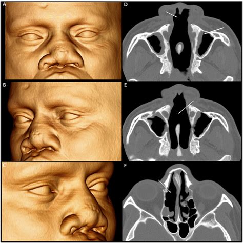 Volume Rendered 3d Images Of Multi Slice Ct Data A B And C And Axial