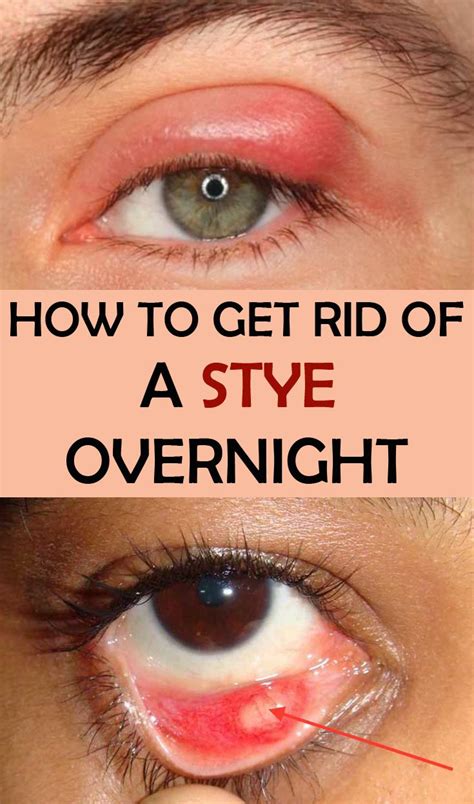How To Get Rid Of A Stye Overnight Healing The Organic Way Eye Stye