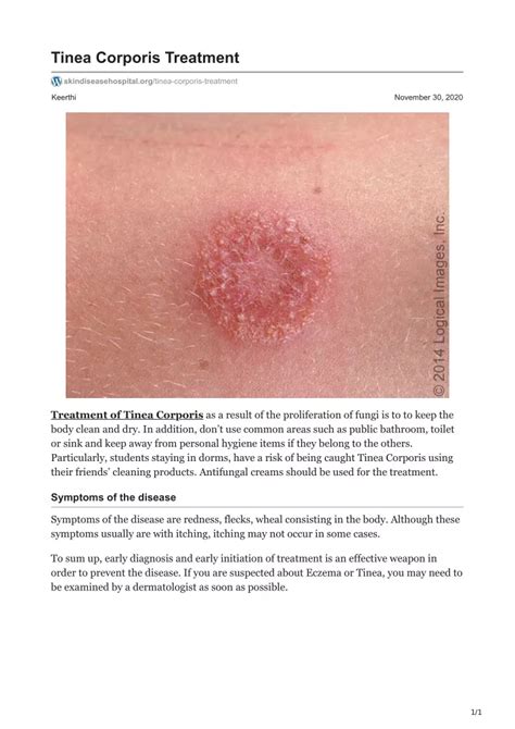 Ppt Tinea Corporis Treatment Powerpoint Presentation Free Download