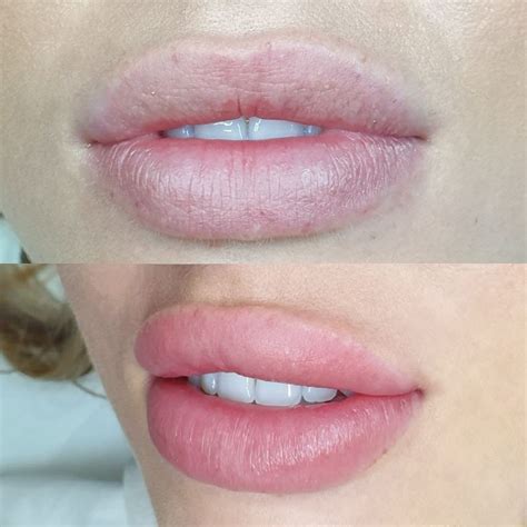 How To Get Pink Lips Permanently Treatment Lipstutorial Org