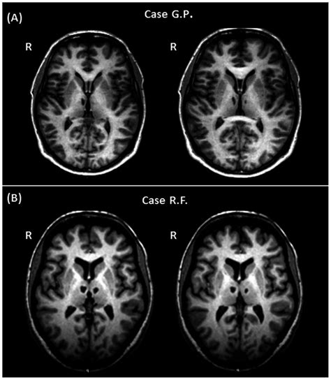 Bilateral Thalamic Damage Detectable On T1 Weighted Images Of The Two