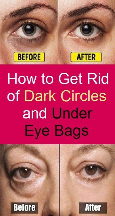 How To Get Rid Of Dark Circles And Under Eye Bags Eye Bag Remedies