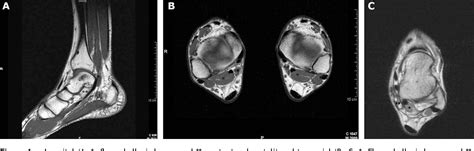 Figure 2 From Tarsal Tunnel Syndrome And Flexor Hallucis Longus Tendon