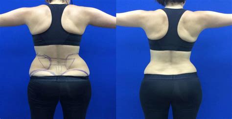 Liposuction To Liposculture Brazilian Butt Lift Blog