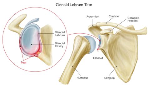 Glenoid Labral Tears Shoulder Pain Conditions Diagnosis And