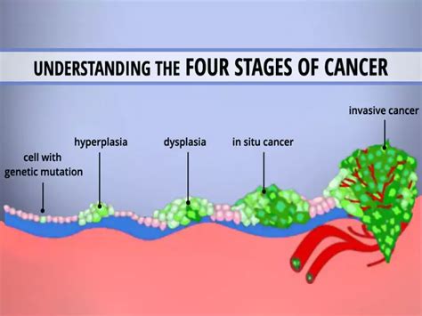 What Is Stage 4 Cancer Its Not A High Score You Want