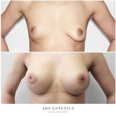 Kształt piersi mały biust duży biust asymetria Ars Estetica