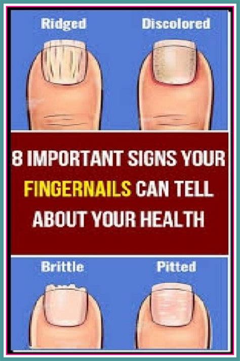 Ridges In Fingernails Types Causes And Treatment Artofit