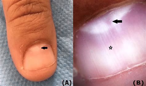 A Discrete Longitudinal Erythronychia On The Right Thumb Nail Arrow