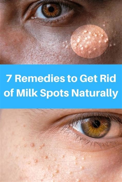7 Remedies To Get Rid Of Cholesterol Milk Spots Naturally Natural Acne