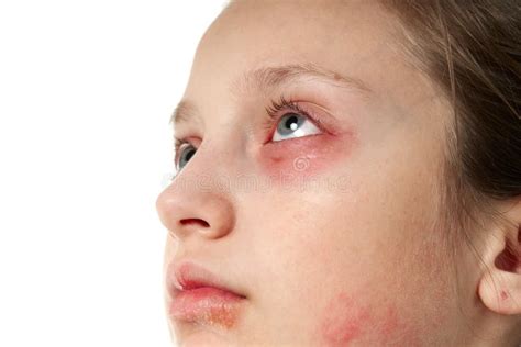 Allergic Reaction Skin Rash Close View Portrait Of A Girl`s Face