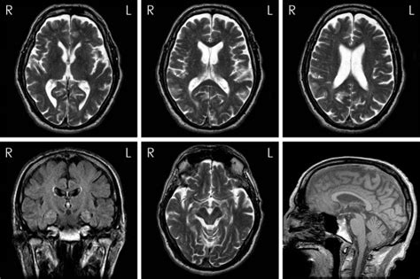 Axial T2 Coronal Flair And Sagittal T1 Brain Magnetic Resonance Images