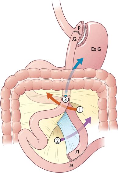 Approaches And Potential Sites For Internal Herniation In Roux En Y