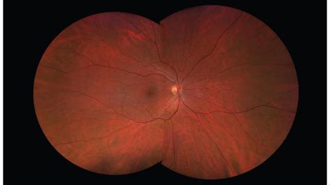 Ultra Widefield Retinal Photograpy