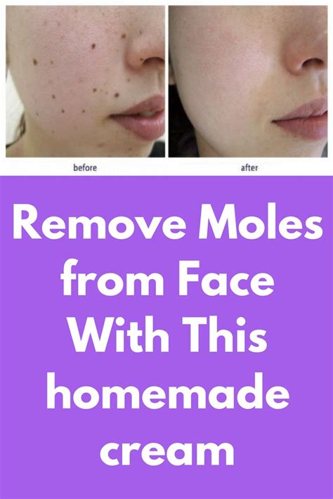 Remove Moles From Face Without Laser With This Homemade Cream Moles