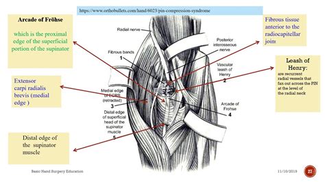 Posterior Interosseos Nerve Dorsal Approach Of The Radius And