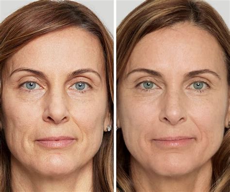 Rid Your Face Of Smile Lines With Sculptra Aesthetic The Skin Clinic
