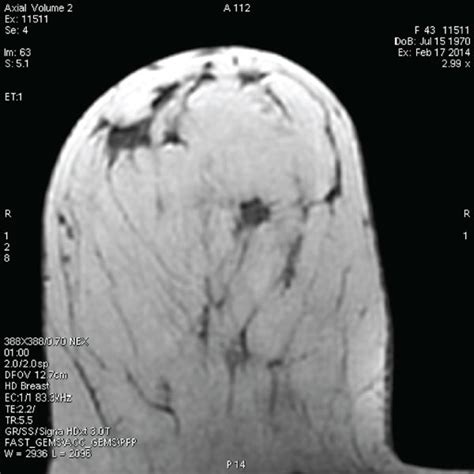 Contrast Enhanced Mri Imaging Of A Cavernous Hemangioma Of The Breast