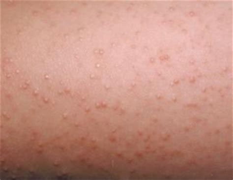 I keep getting these itchy white bumps all over my body that look like mosquito bumps every day. White Bumps on Skin, itchy, Small, Dots, on Arms, Face ...