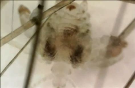 Man 56 Gets Treated To Microscopic View Of His Pubic Louse