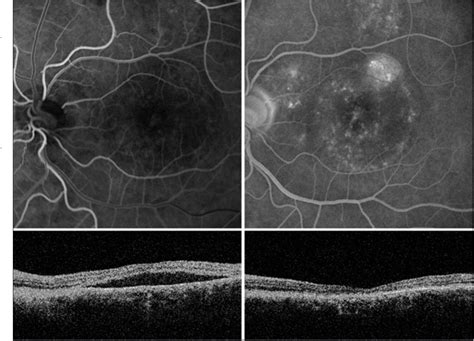 Figure 1 From Intravitreal Bevacizumab For Treatment Of Chronic Central
