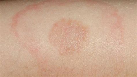 Erythema Migrans Identification Treatment And More