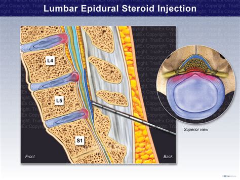 Lumbar Epidural Steroid Injection Trial Exhibits Inc