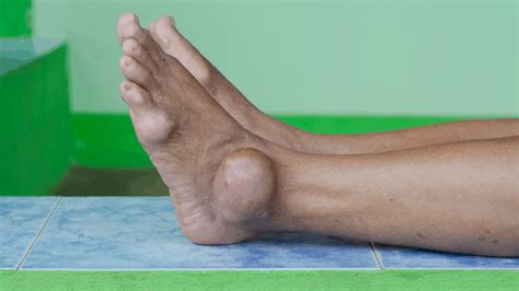 9 Pictures Of The Gout Symptoms Food To Avoid Other Tips