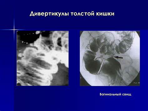 Диета дивертикулы толстой кишки Методики исследования толстой кишки. Заболевания толстой кишки Методики исследования толстой кишки. Заболевания толстой кишки Диета дивертикулы толстой кишки