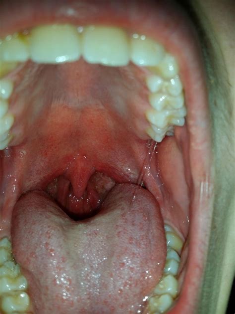 White Spots In The Back Of My Mouth Tonsils It Hurts When I Swallow