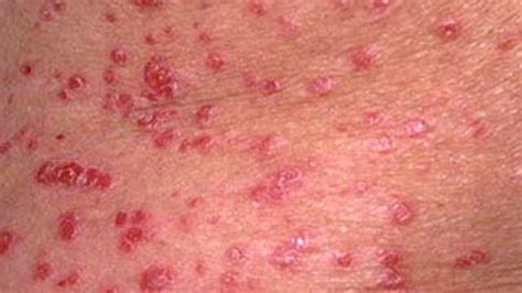 Guttate Psoriasis Causes Diagnosis And Treatments